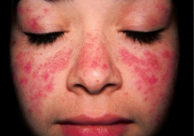 Lupus ban đỏ dạng đĩa: Dấu hiệu, nguyên nhân và cách điều trị bệnh hiệu quả